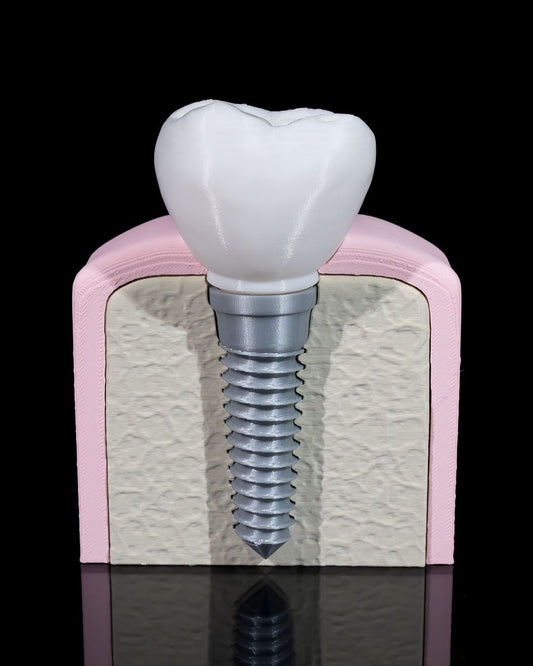 Implant Dentar