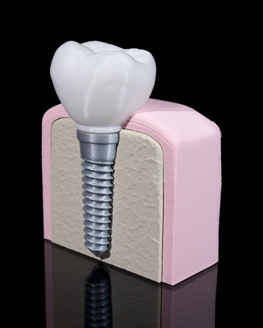 Implant Dentar